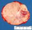 Adrenal differentiating neuroblastoma