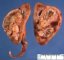 Botryoid Wilms tumor