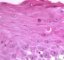 Apoptotic epithelial cell in esophageal GVHD
