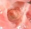 Parietal left ventricular polyp in aortic arch hypoplasia