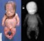 Thanatophoric dysplasia