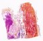 Ewing sarcoma in spongious bone