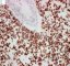 Botryoid embryonal rhabdomyosarcoma of the rhinopharynx (Desmin)