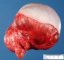Congenital sacrococcygeal immature teratoma