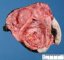 Congenital sacrococcygeal immature teratoma