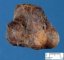 Hashimoto thyroiditis with nodular hyperplasia