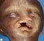 Nasolabiopalatal cleft (Fetus, 20 weeks)