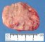 Neuroblastoma