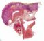 Obstructive renal dysplasia