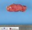 Paratesticular Leydig cell tumor
