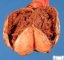 Paratesticular hematoma