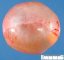 Ovarian cystic mature teratoma