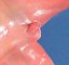 Fetal penis 24 weeks