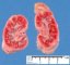 Renal tubular dysgenesis