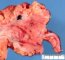 Crohn colitis