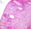 Colonic localization of an infantile myofibromatosis