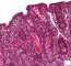 Intestinal cystic fibrosis with villous atrophy