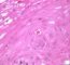 Apoptotic epithelial cell in esophageal GVHD