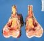 Femoral osteosarcoma