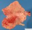 Submucosal gastric hemorrhages in systemic fungal dissemination