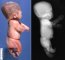 Thanatophoric dysplasia