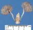 Fetal oligocystic kidneys of unknow cause (case 11389)