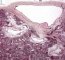 Fetal oligocystic kidneys of unknow cause (case 11389)