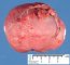 Primitive myxoid mesenchymal tumor of infancy (PMMTI)