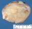 Primitive myxoid mesenchymal tumor of infancy (PMMTI)