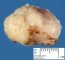 Mammary fibroadenoma