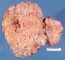 Sarcoma in mediastinal teratoma