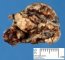 Leptomeningeal arteriovenous malformation