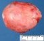 Ovarian endometriotic cyst