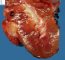 Perilobar nephrogenic rest