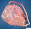 Velamentous insertion of umbilical cord on the amniotic membrane