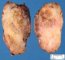 Thyroid papillary carcinoma