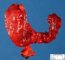 Thyroid papillary carcinoma