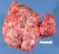 Mediastinal teratoma. Macroscopy