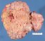 Mediastinal teratoma. Macroscopy