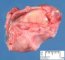 Ovarian mature teratoma