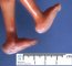 Rocker-bottom foot in a Pena-Shokeir syndrome