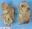 Renal tuberculosis