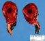 Adrenal hematoma