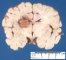 Aspergillus cerebral abcess