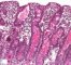 Intestinal cystic fibrosis with villous atrophy