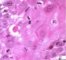 Apoptotic epithelial cell in esophageal GVHD