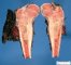 Femoral Ewing sarcoma