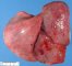 Subpleural hemorrhages in systemic fungal dissemination