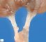 Ureteral duplication in a horseshoe kidney