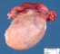 ovarian Leydig cell tumor